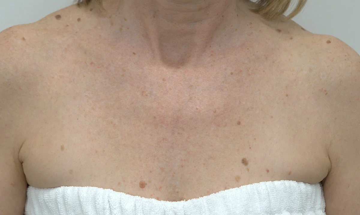 After BBL® HEROic™, Chest sun damage · BBL® HEROic™