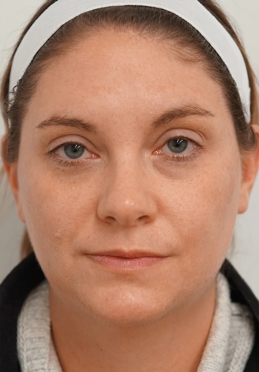 After BBL® HEROic™, Brown spots + redness · BBL® HEROic™