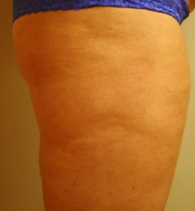 After HALO®, Body texture · HALO®