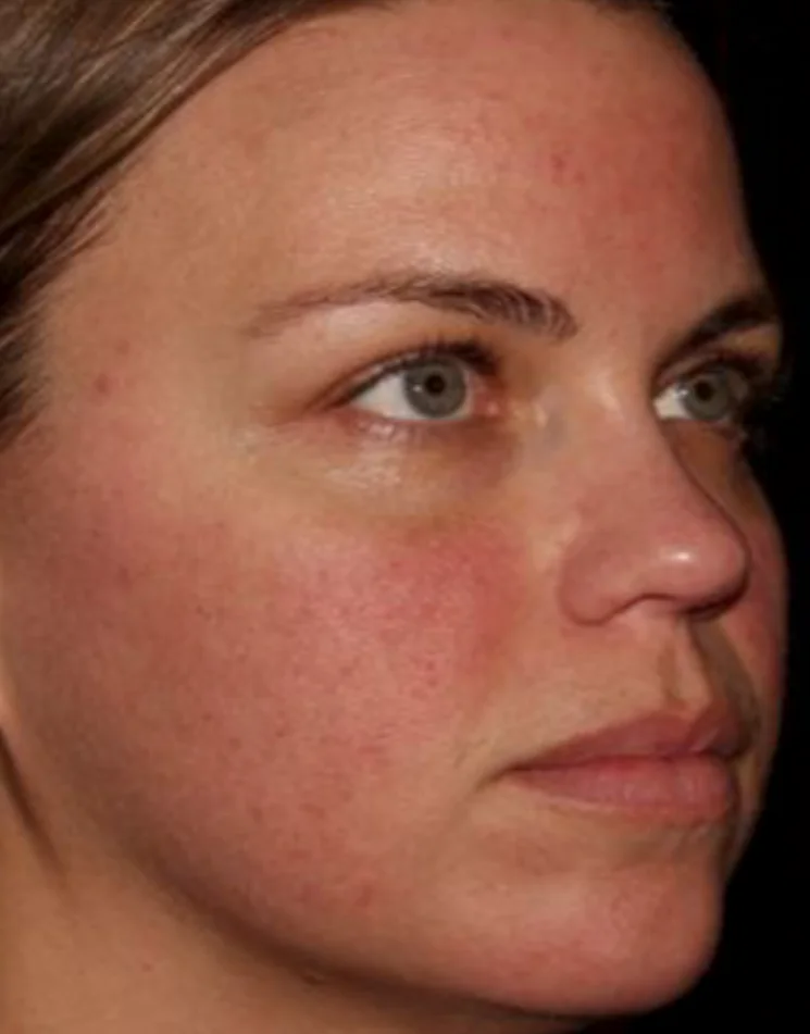 After HALO®, Texture + redness · HALO®