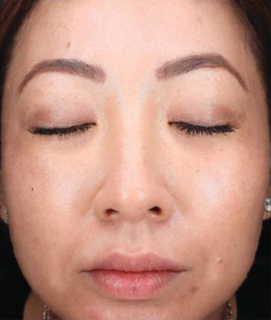 After HALO® TRIBRID™, Pigment + tone · 1 treatment