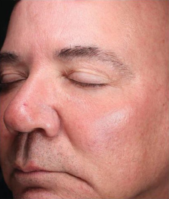 After HALO® TRIBRID™, Texture + redness · 1 treatment