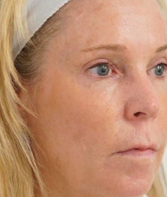 After HALO® TRIBRID™, Sun damage · with BBL® HEROic™