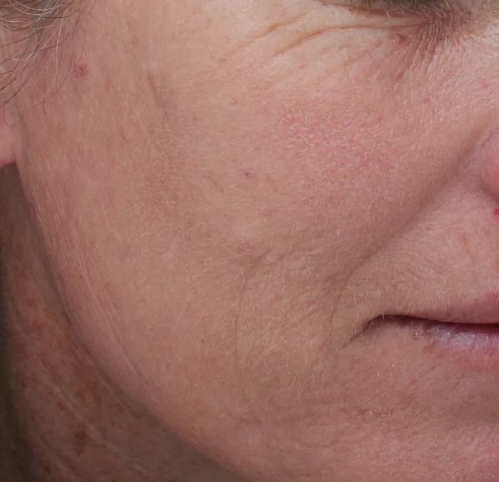 After MOXI®, Tone + sun damage · MOXI®