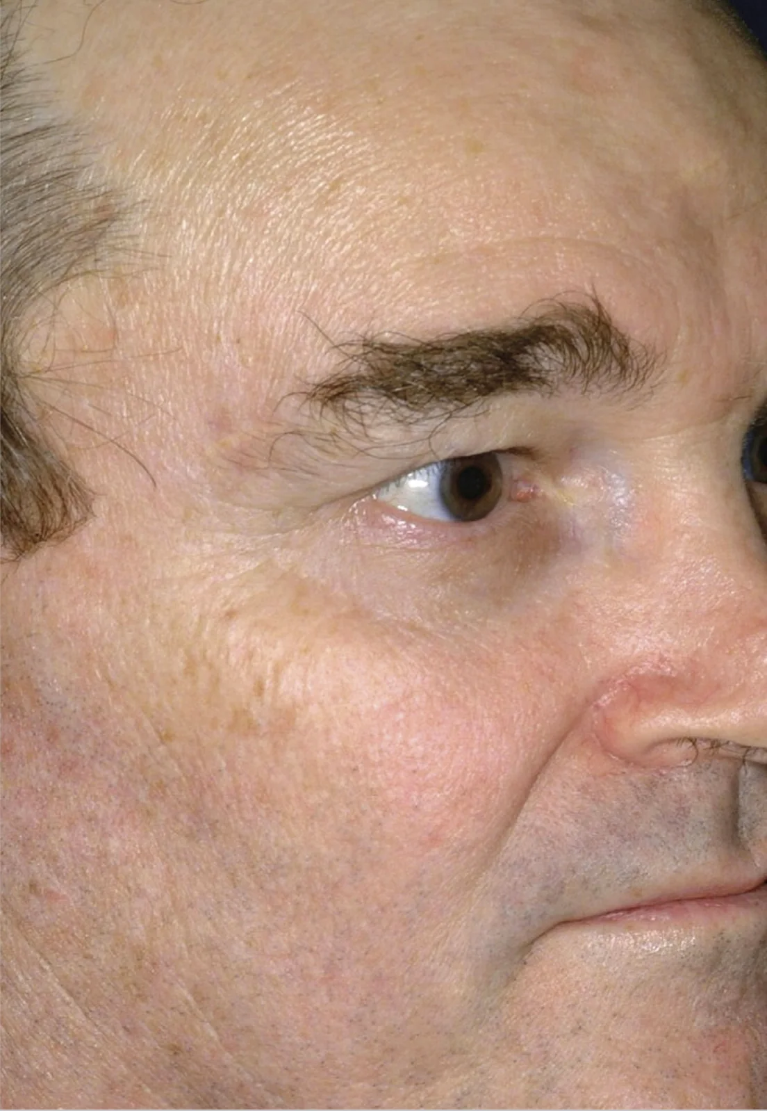 After Sciton® Laser Peels, Sun damage + texture · MicroLaserPeel®