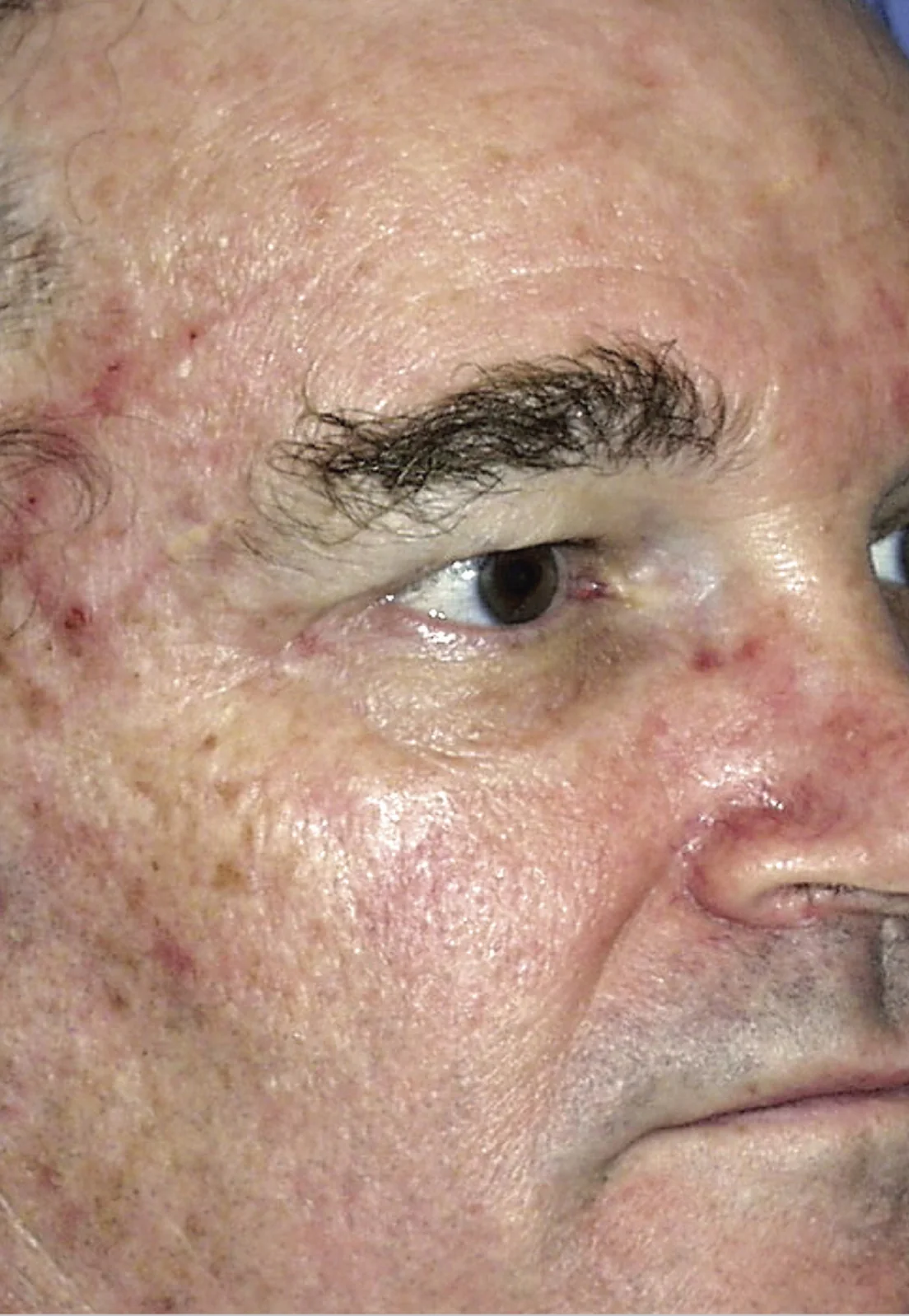 Before Sciton® Laser Peels