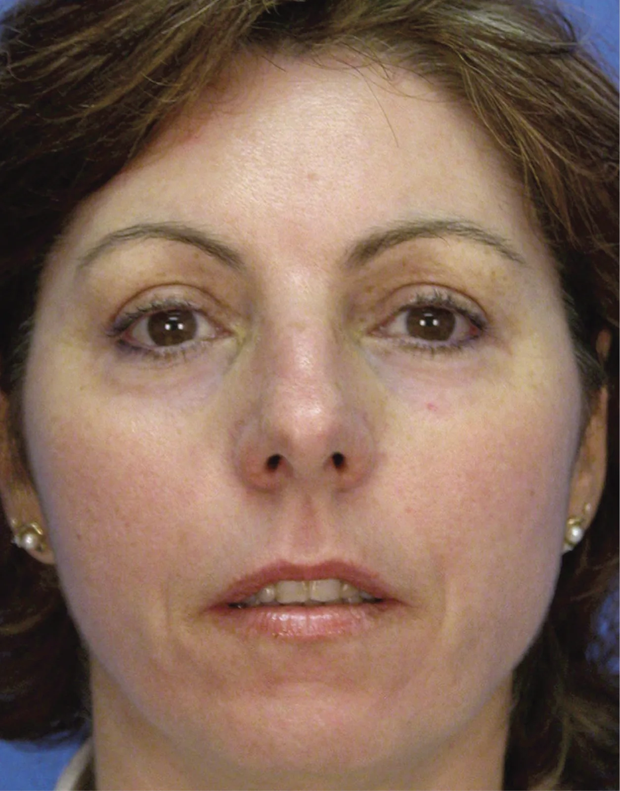 After Sciton® Laser Peels, Sun spots + tone · MicroLaserPeel®