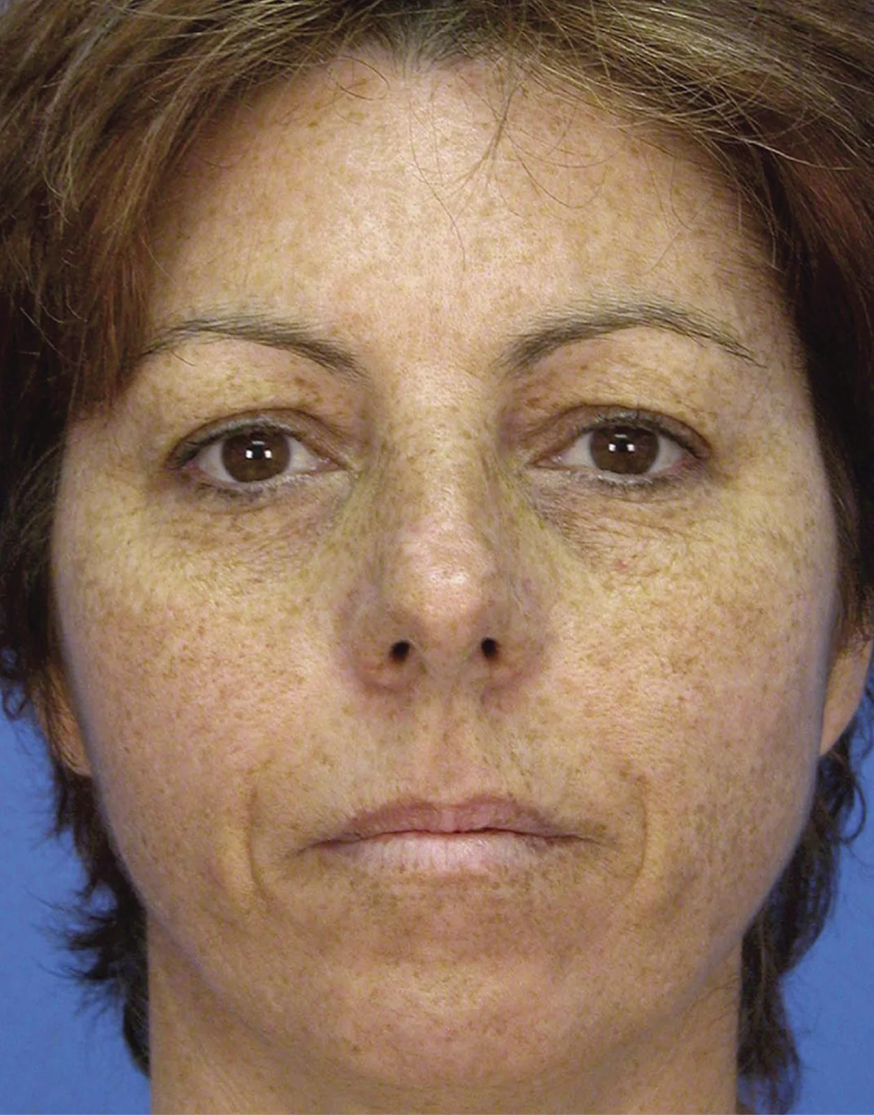 Before Sciton® Laser Peels