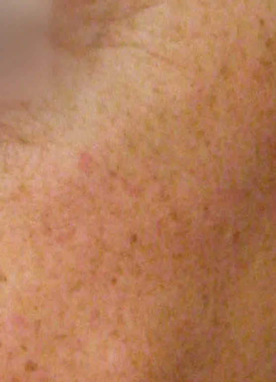 After Sciton® Laser Peels, Fine texture · NanoLaserPeel™