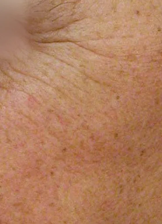 Before Sciton® Laser Peels