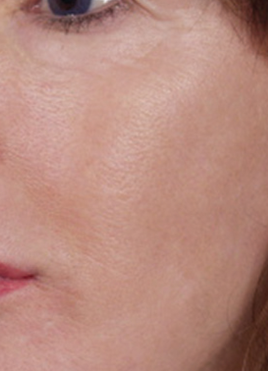 After Sciton® Laser Peels, Tone + glow · NanoLaserPeel™