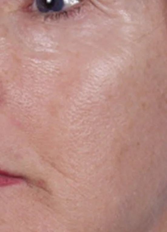 Before Sciton® Laser Peels